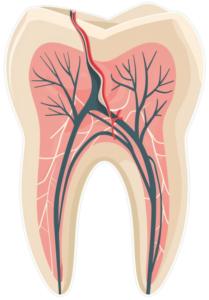 Tratamiento especializado para fracturas dentales en Bogotá